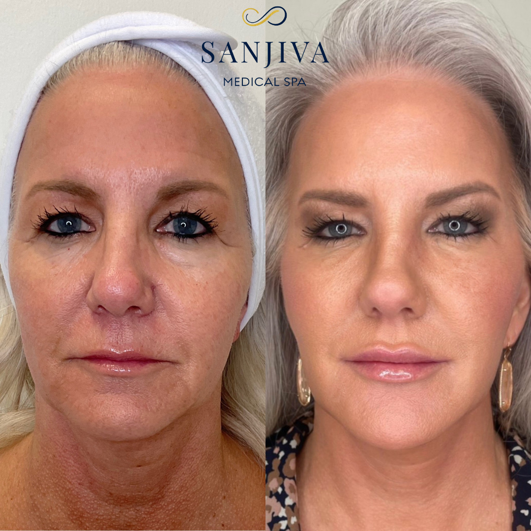 Impressive before and after image of a woman's face, showcasing the transformative results of dermal fillers for a more youthful and rejuvenated appearance.