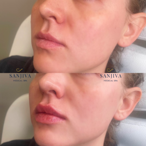Stunning before and after photo of a woman's face, highlighting the remarkable effects of lip fillers for fuller, plumper, and more defined lips