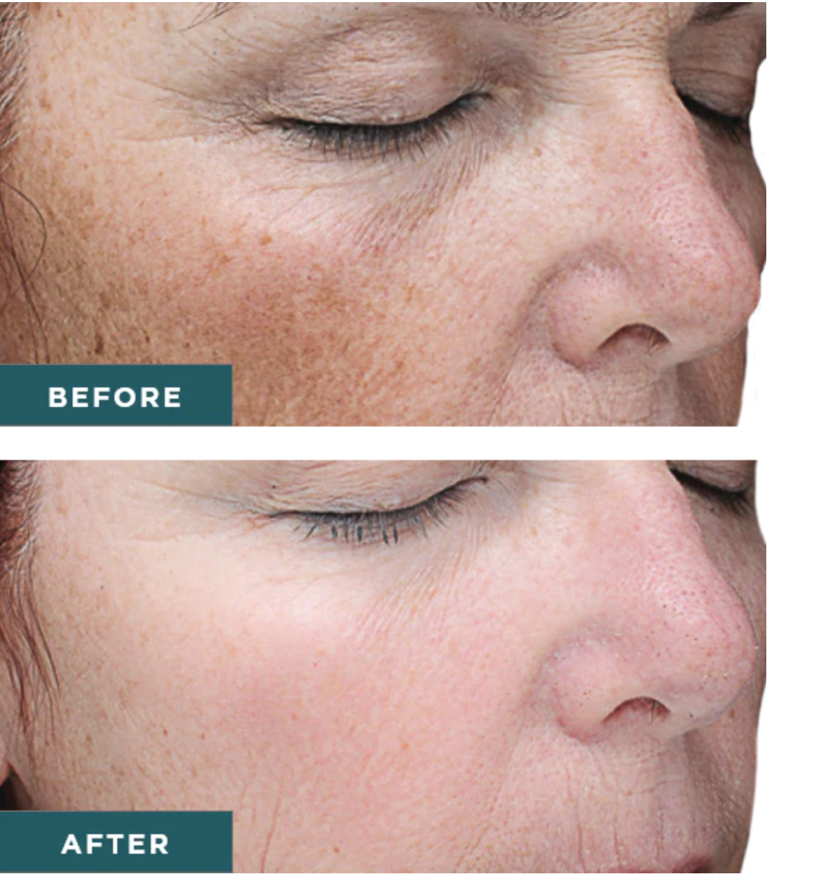 VI Chemical Peel Before and After