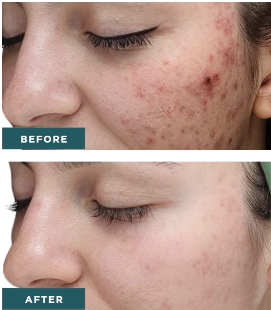 VI Chemical Peel before and after