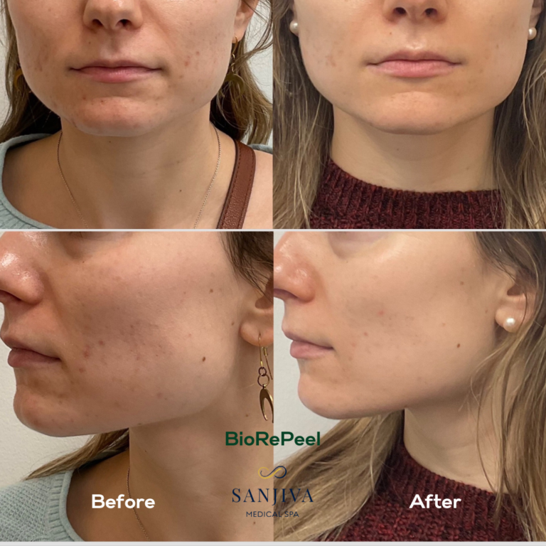 Before and after Biorepeel treatment at Sanjiva Medical Spa, showcasing significant acne improvement in a young woman.