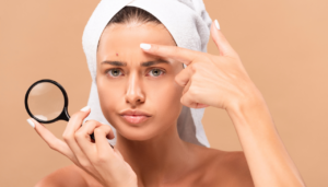 acne chemical peel dallas