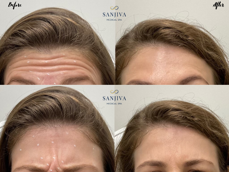 Botox before afters at sanjiva Medcial spa in Dallas