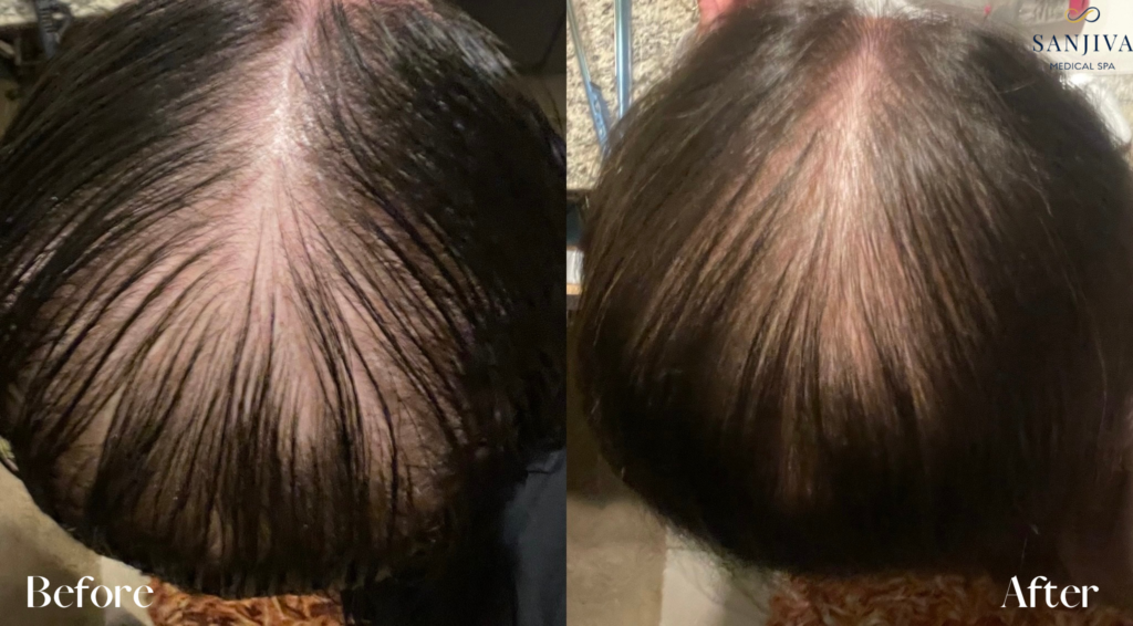 Exosomes hair before after