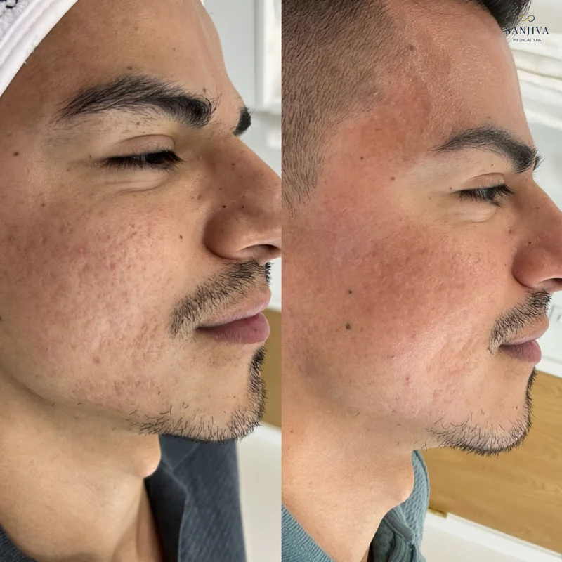 Expert Acne Scar Treatment in Dallas | Sanjiva Medical Spa