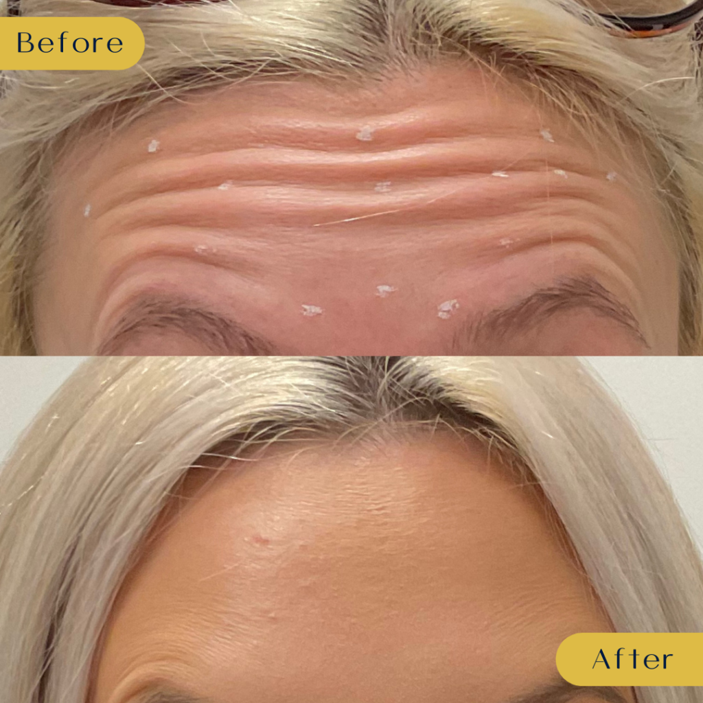Dysport and Botox wrinkle relaxer results in Dallas at Sanjiva Medical Spa