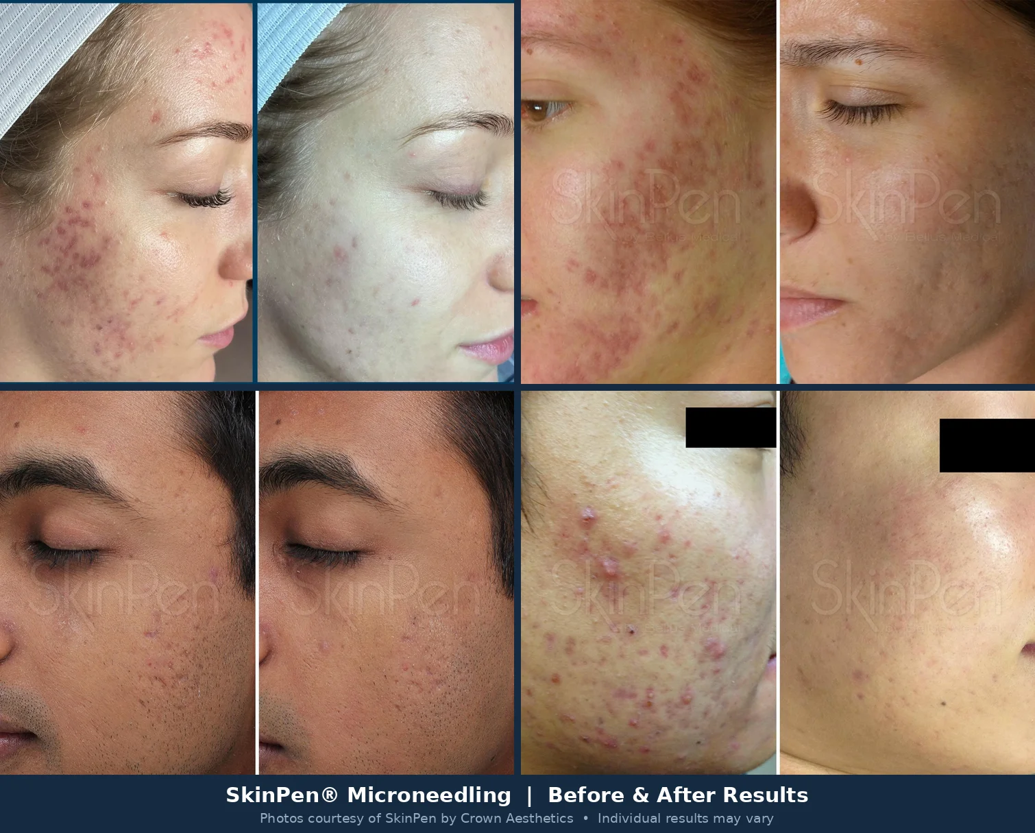 SkinPen microneedling before and after acne scars in Dallas