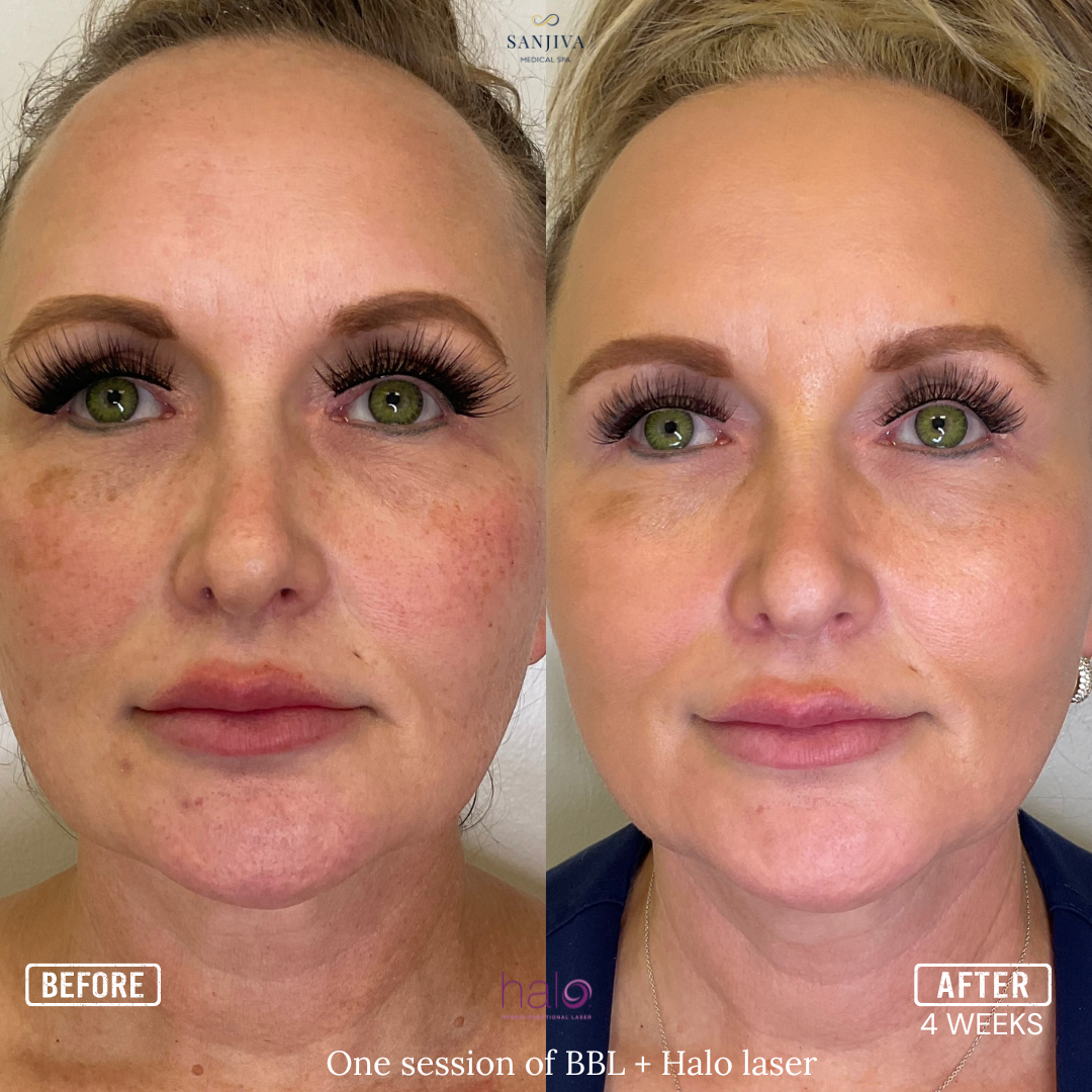 Before and after one session of combined BBL Photofacial and Halo laser at Sanjiva Medical Spa in Dallas, showing reduced brown spots, redness, and improved skin texture at four weeks