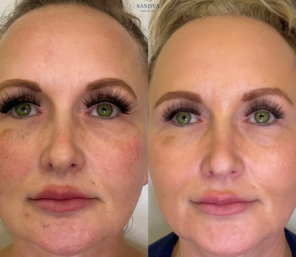 Hyperpigmentation & Dark Spot Treatment Dallas