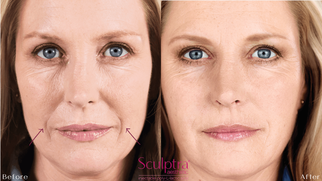Sculptra before after of face in dallas